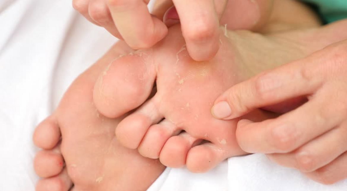 Skin Beauty: Peeling Skin on Hands and Feet
