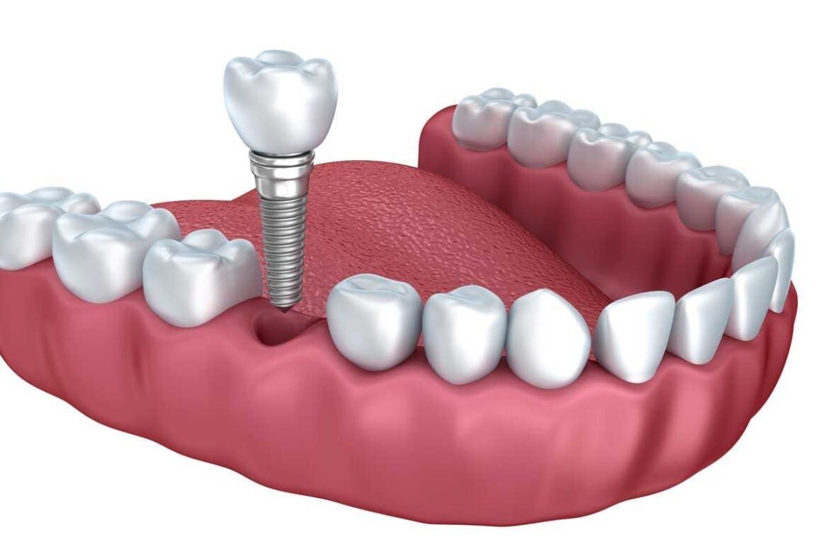 Dental Implants